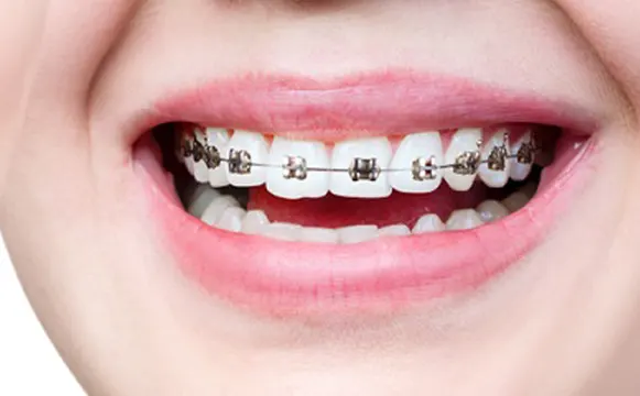 braces-before braces-before
