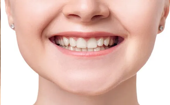 dental-implant-after dental-implant-after