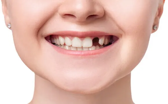 dental-implant-before dental-implant-before