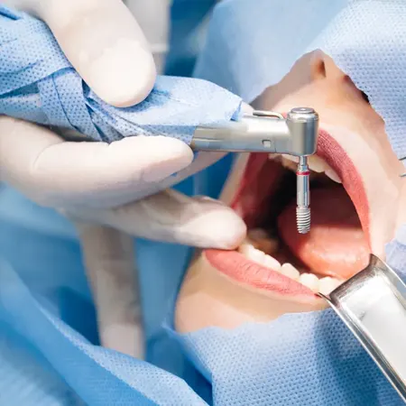 dental implants