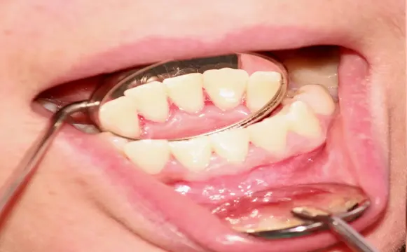 teeth-polishing-after teeth-polishing-after