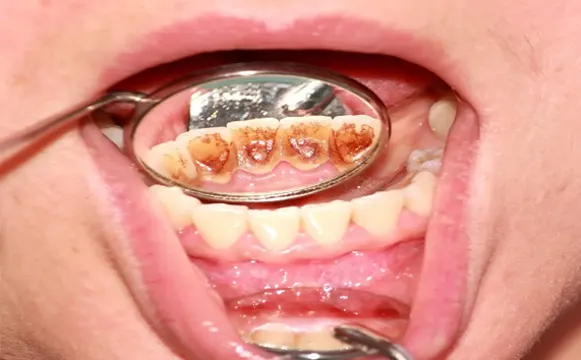 teeth-polishing-before teeth-polishing-before