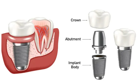 dental implant system
