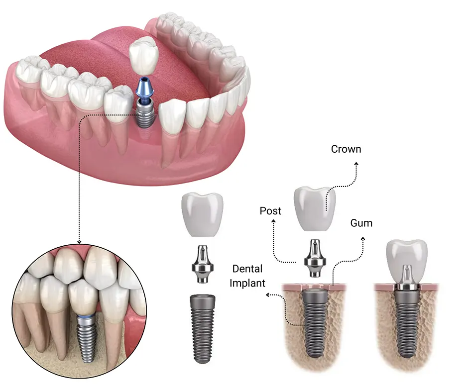 single tooth implant